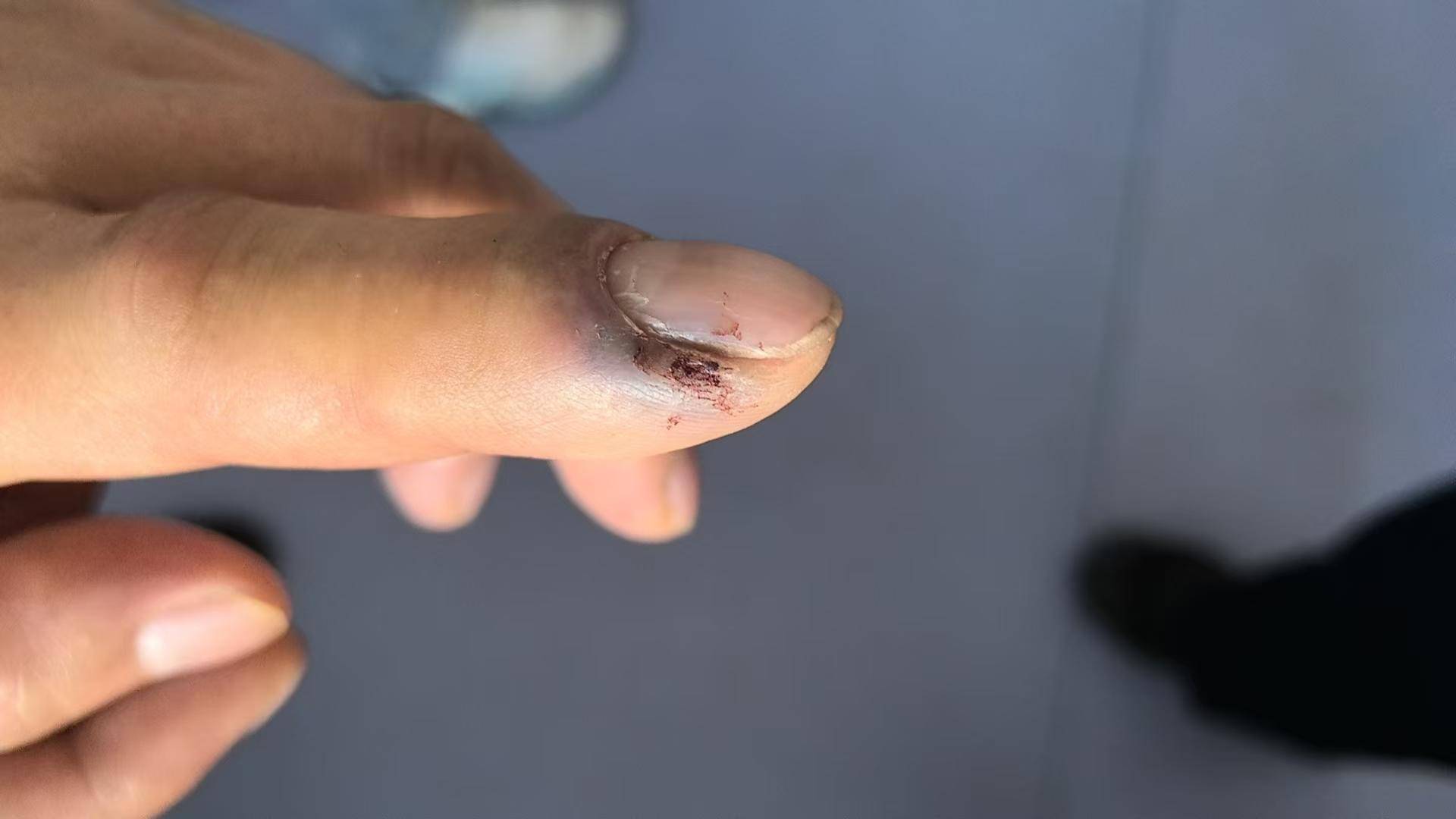 青海一男子被罕见剧毒阿拉善蝮蛇咬伤,因无血清一度想放弃治疗 警车开道转运700公里救命