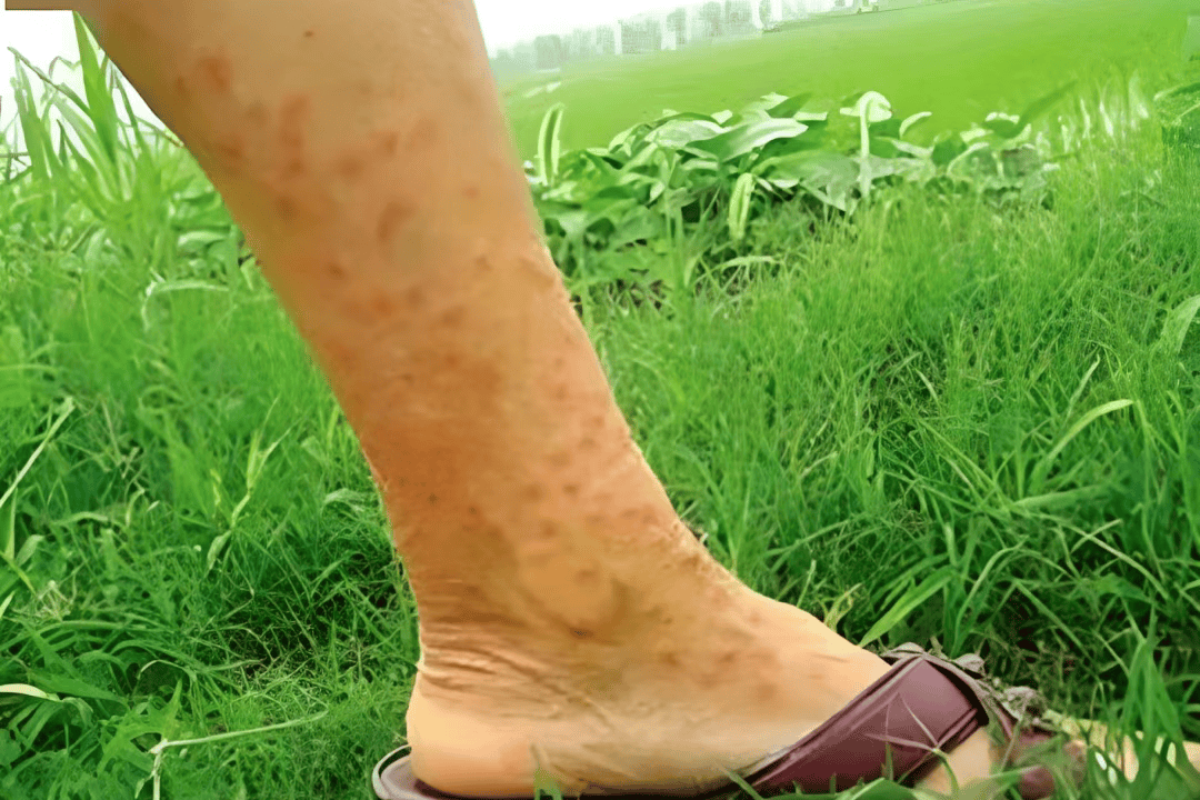 一旦接触,10秒即可感染!汛期谨防这种病→