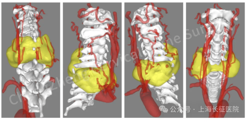 全球罕见!中国医生救回“身首离断”患者