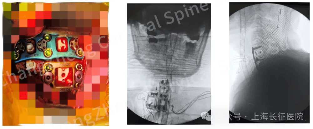 全球罕见!中国医生救回“身首离断”患者