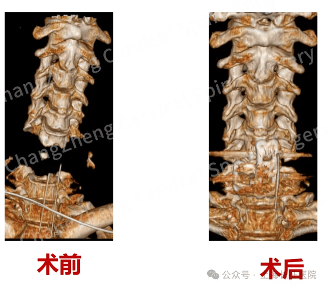 全球罕见!中国医生救回“身首离断”患者