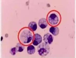 24岁女演员确诊“癌王”,崩溃痛悔:大家别像我这样