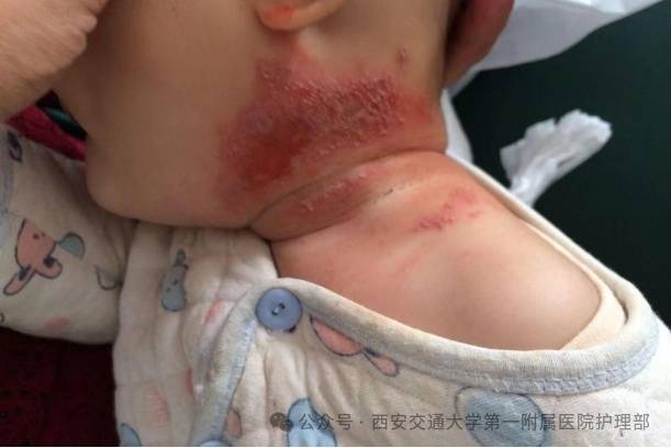 西安多区发现隐翅虫?千万别拍!毒液堪比硫酸